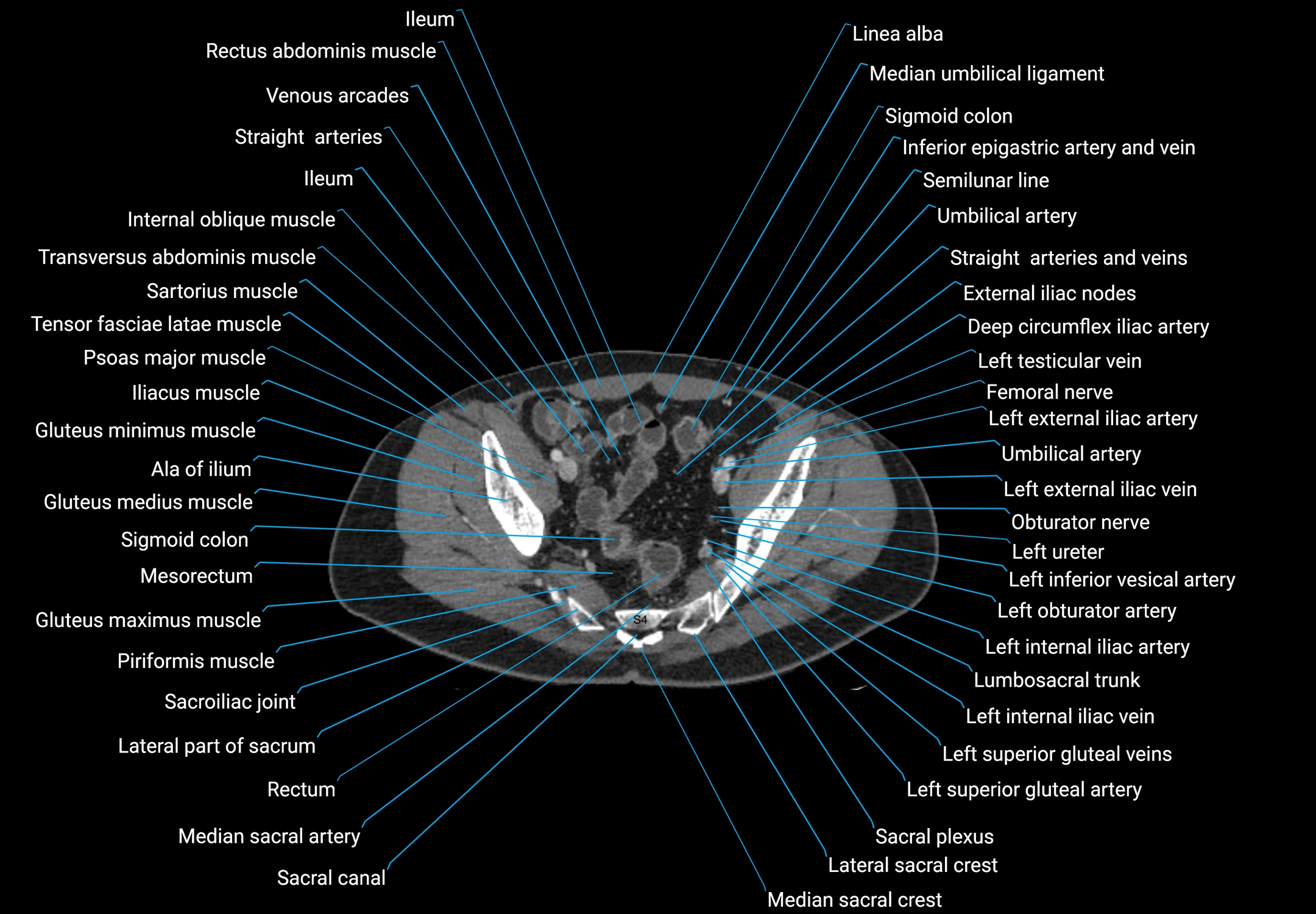 CT male pelvis axial cross sectional anatomy labelled radiology image -00165.webp